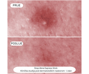 Stop Akne Express Stick