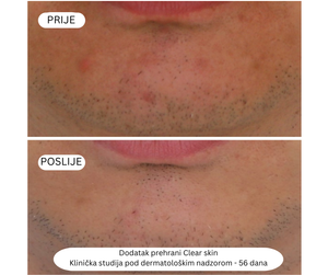 Clear skin - Čista koža