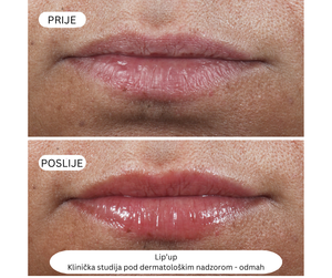 Lip´up Booster za usnice