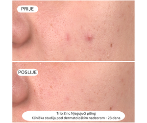 Trio Zinc njegujući piling