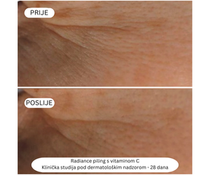 Radiance piling s Vitaminom C